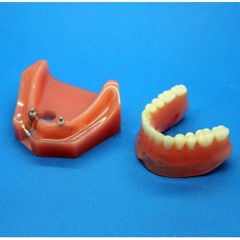 Dental Impant Modelo Para Reparación M-6007